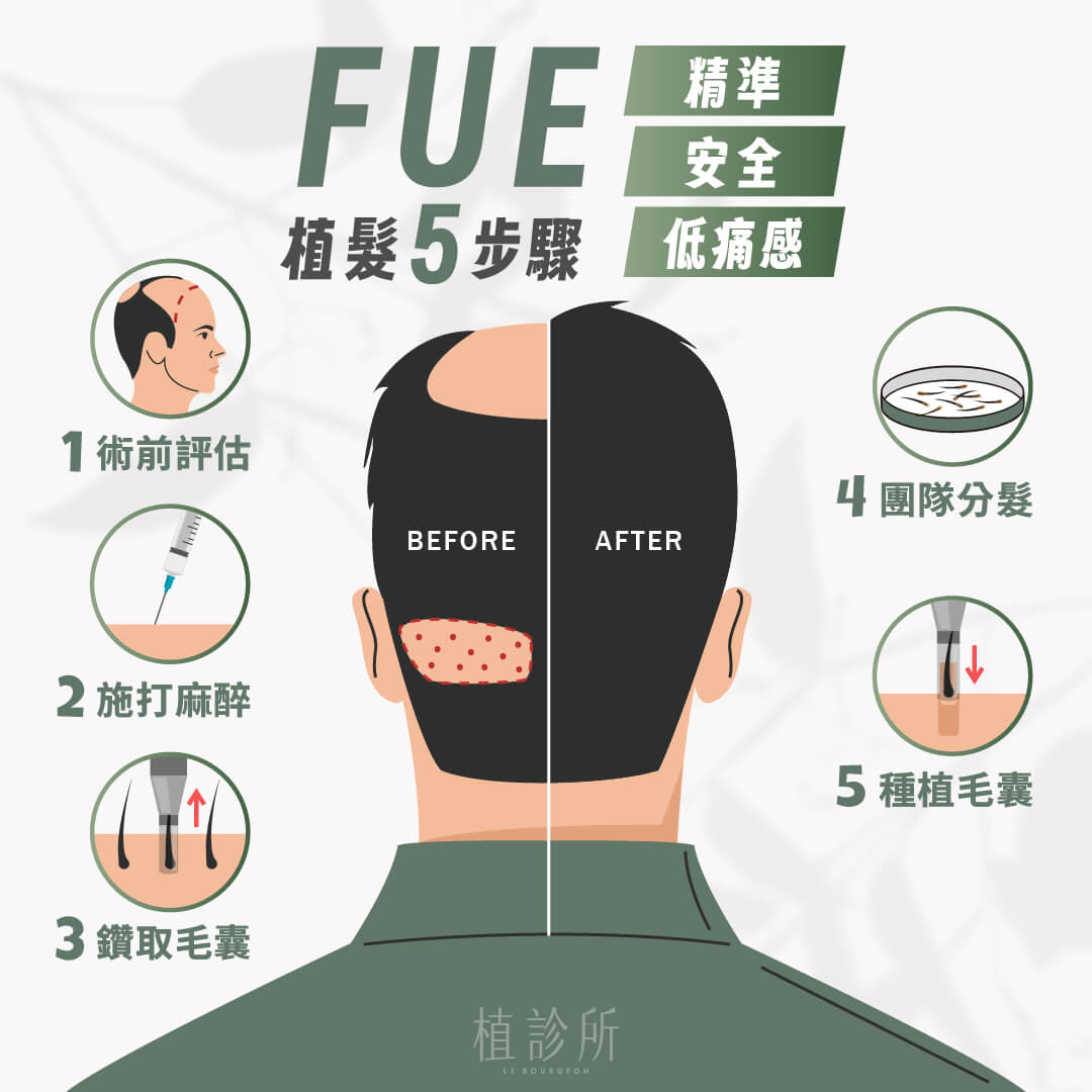 FUE植髮5步驟