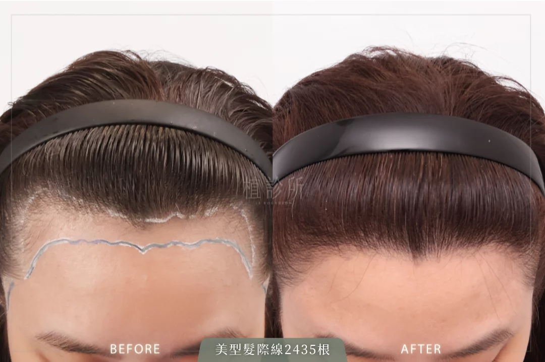 2435根美型髮際線