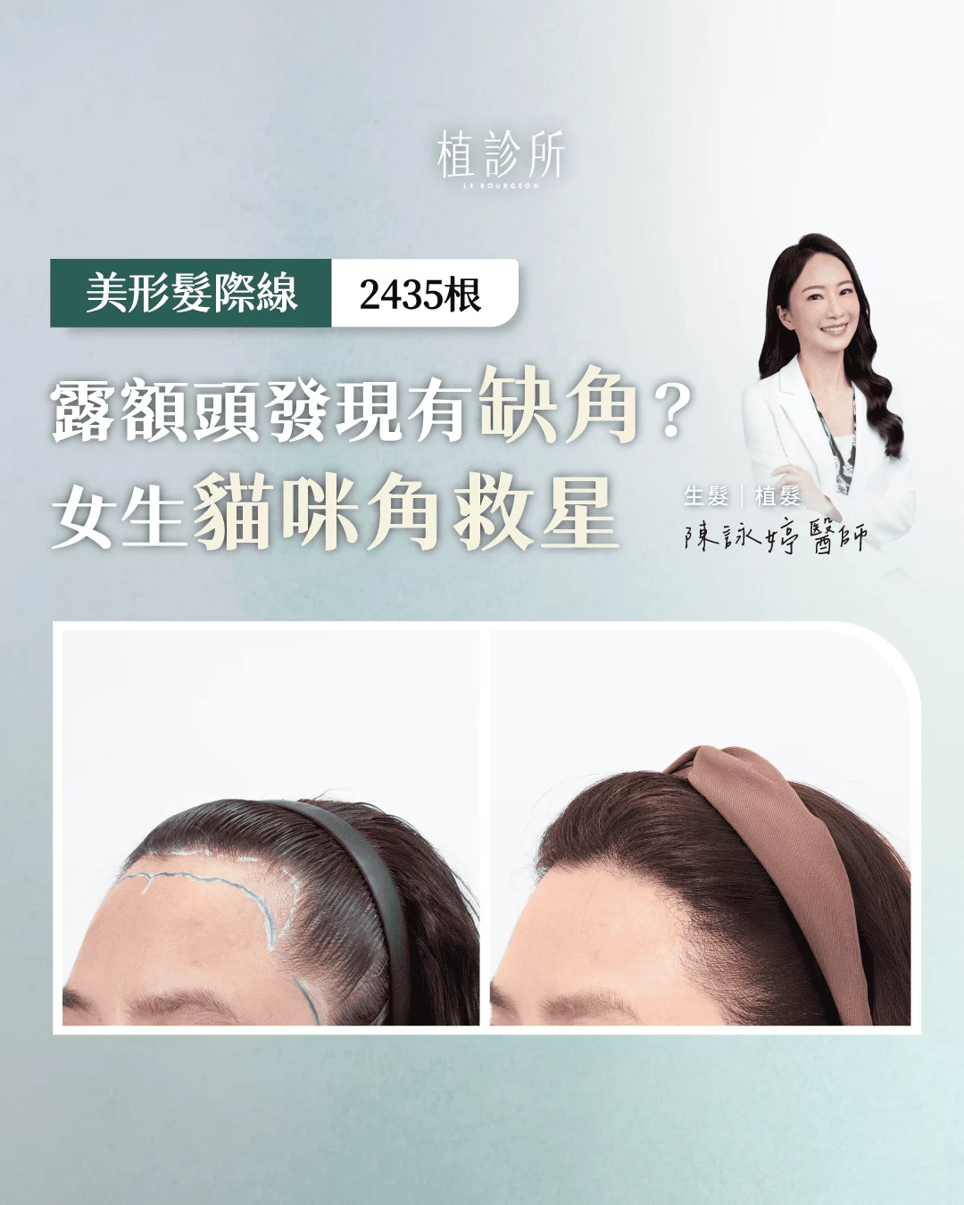美型髮際線