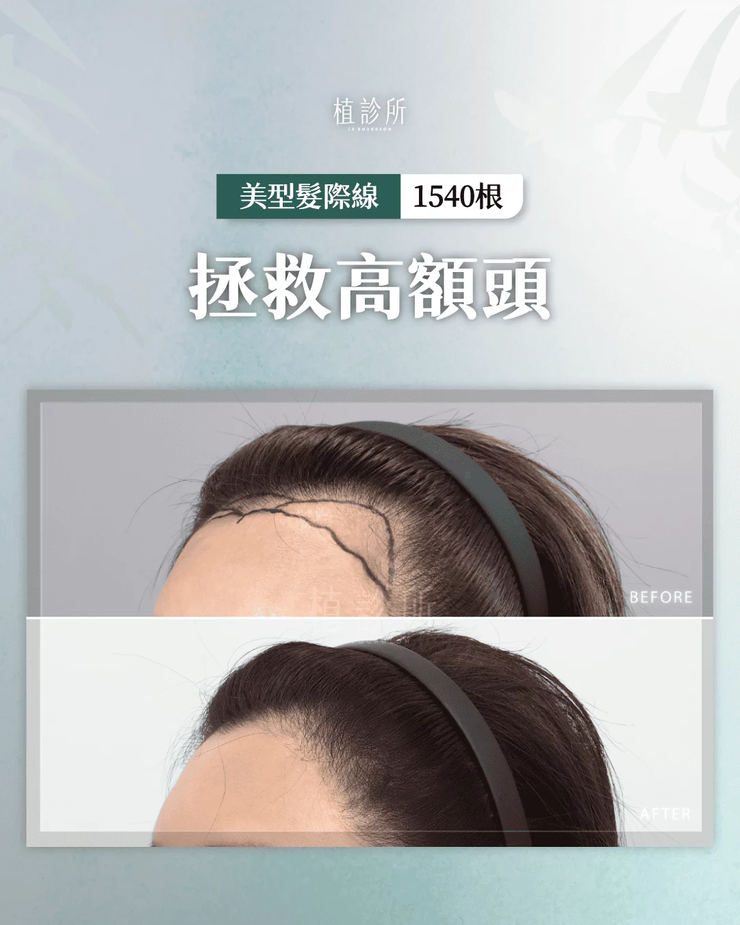美型髮際線植髮