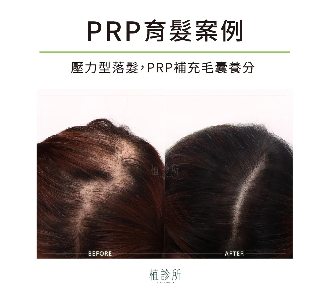 prp育髮案例