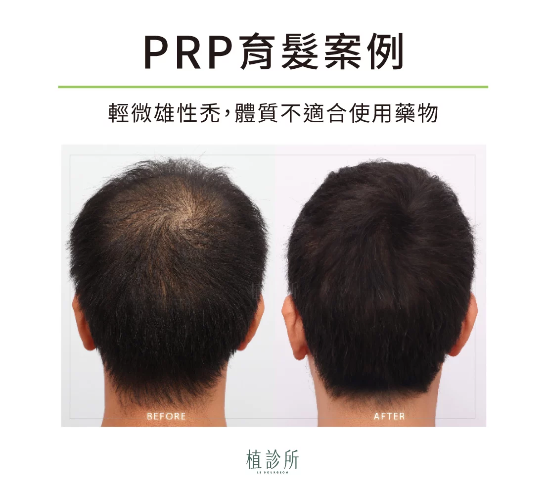 prp育髮案例