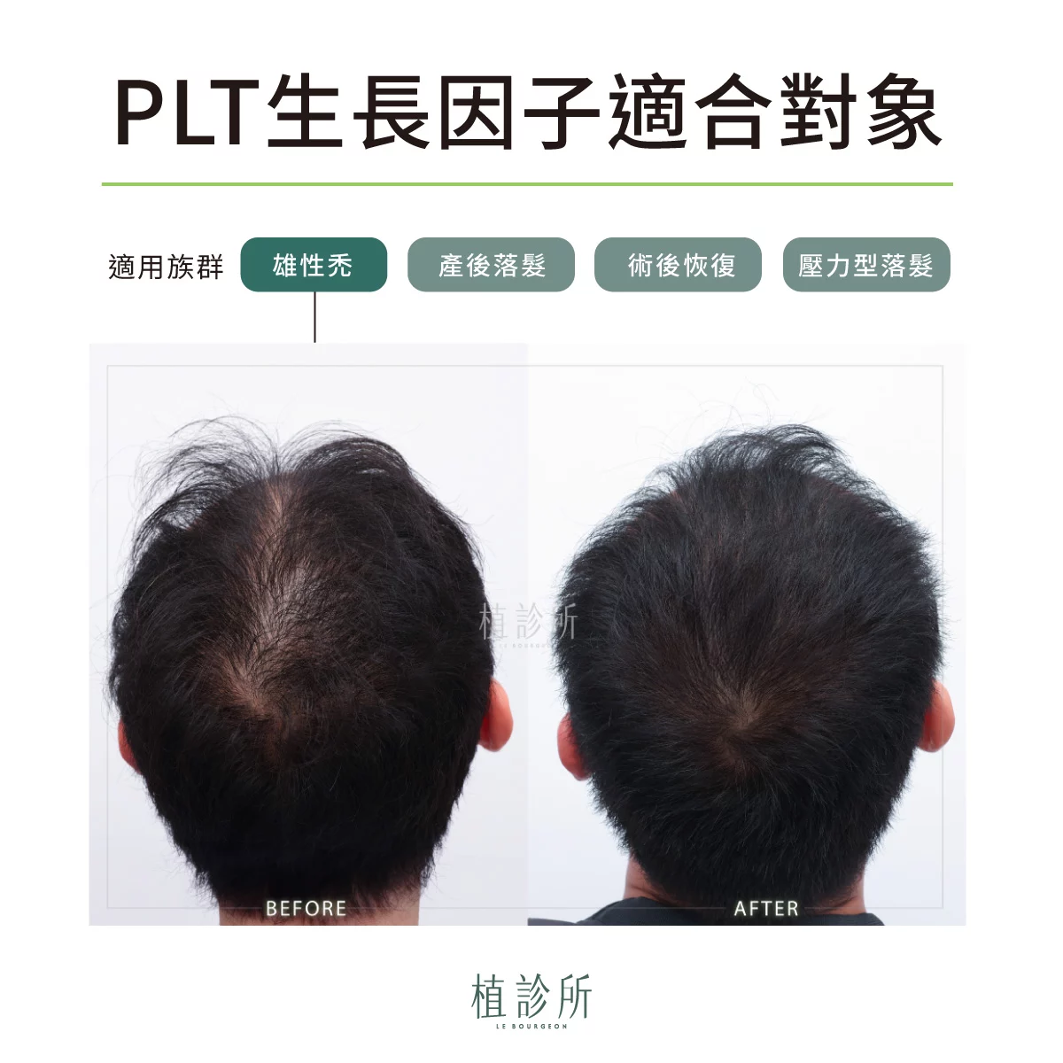 PLT 生長因子 適合對象