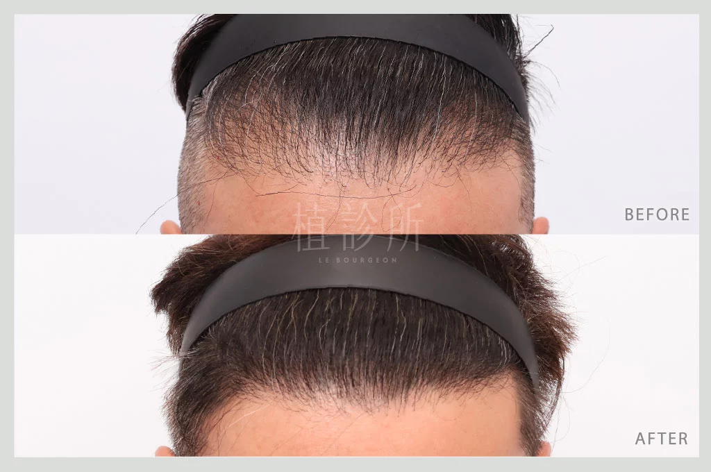 植髮案例M型3310根 低頭