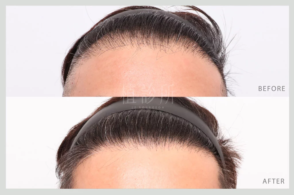 植髮案例3310根 正面