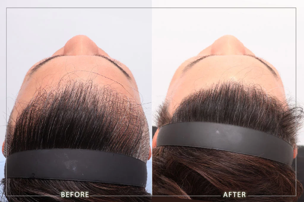 植髮案例M型3310根 頭頂 9個月