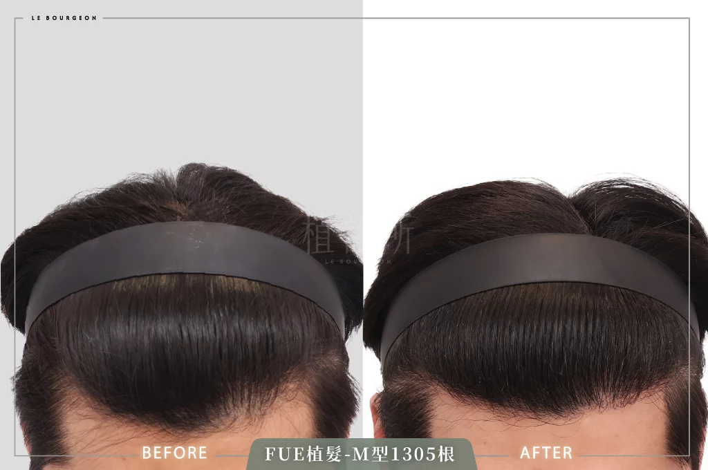 L先生 FUE植髮 1305根