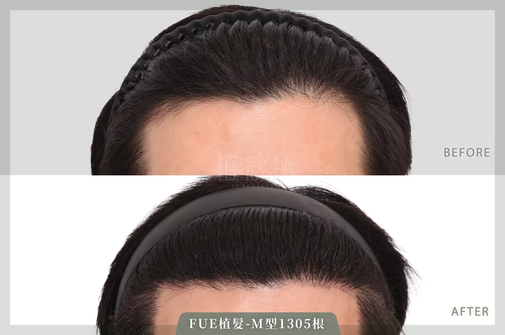 L先生 FUE植髮 1305根