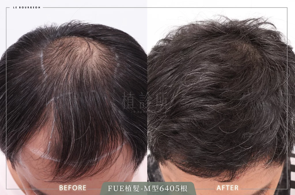 20250527 FUE植髮 L 正面1