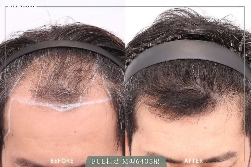 20250527 FUE植髮 L 正面2