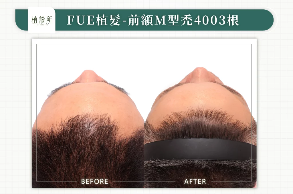 20260106 BA圖 官網醫生案例 前額M型禿 4003根 01