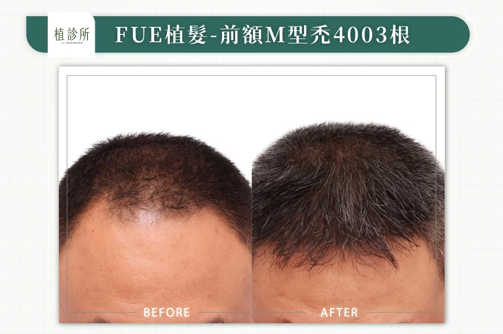 20260106 BA圖 官網醫生案例 前額M型禿 4003根 02
