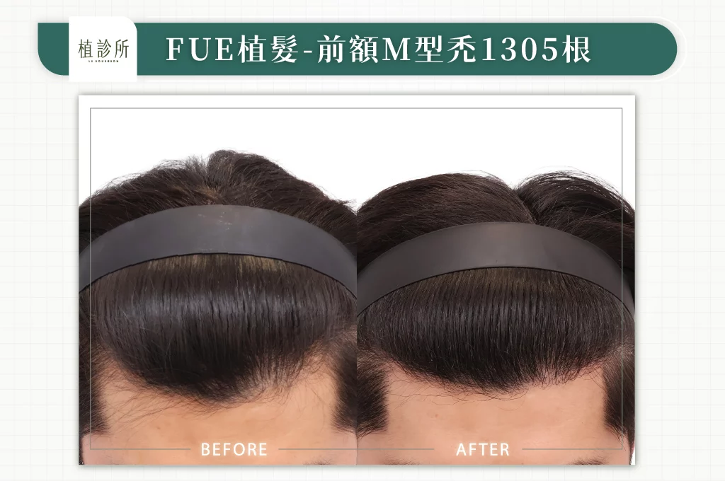 20260106 BA圖 官網醫生案例 前額M型禿 1305根 01