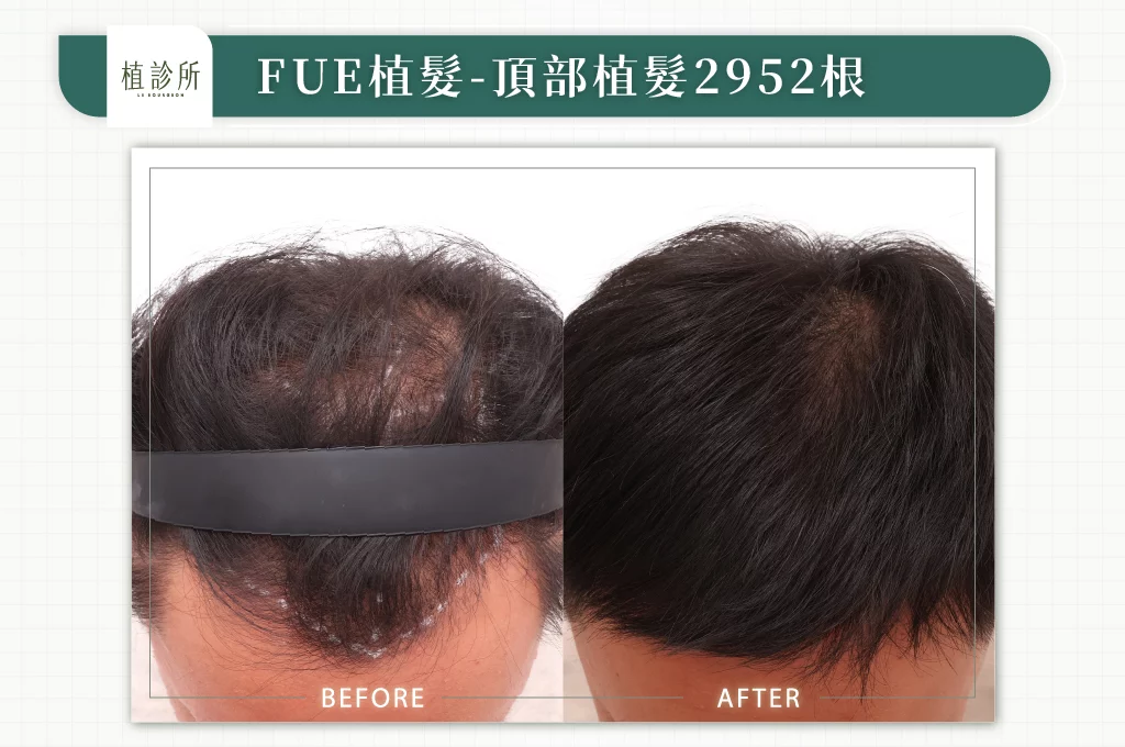 20260106 BA圖 官網醫生案例 頂部植髮2952根 02