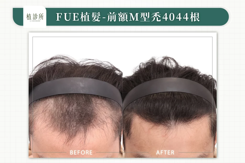 20260106 BA圖 官網醫生案例 前額M型禿 4044根 02