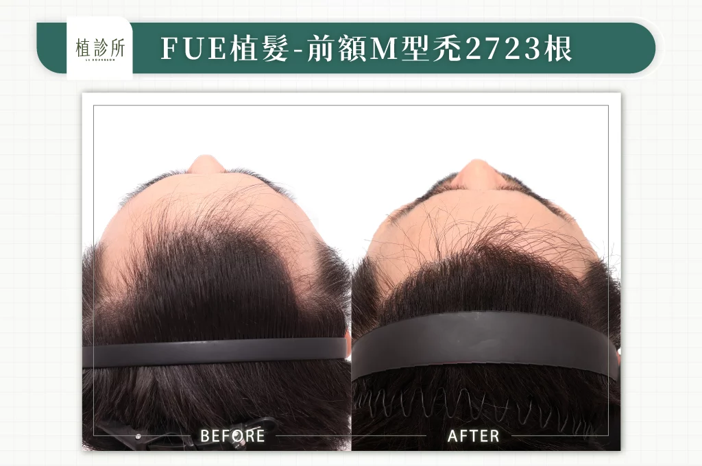 20260106 BA圖 官網醫生案例 前額M型禿 2723根 01