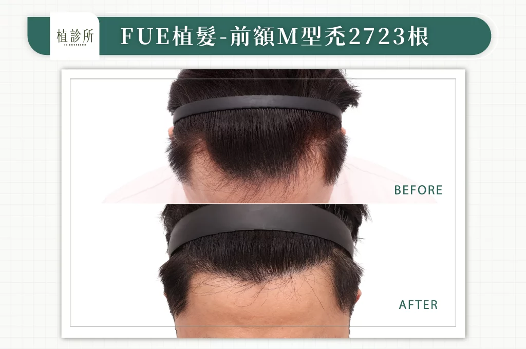 20260106 BA圖 官網醫生案例 前額M型禿 2723根 02