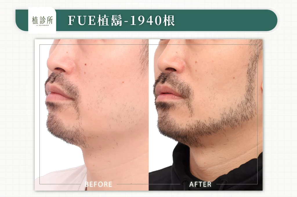20260106 BA圖 官網醫生案例 植鬍 1940根 01