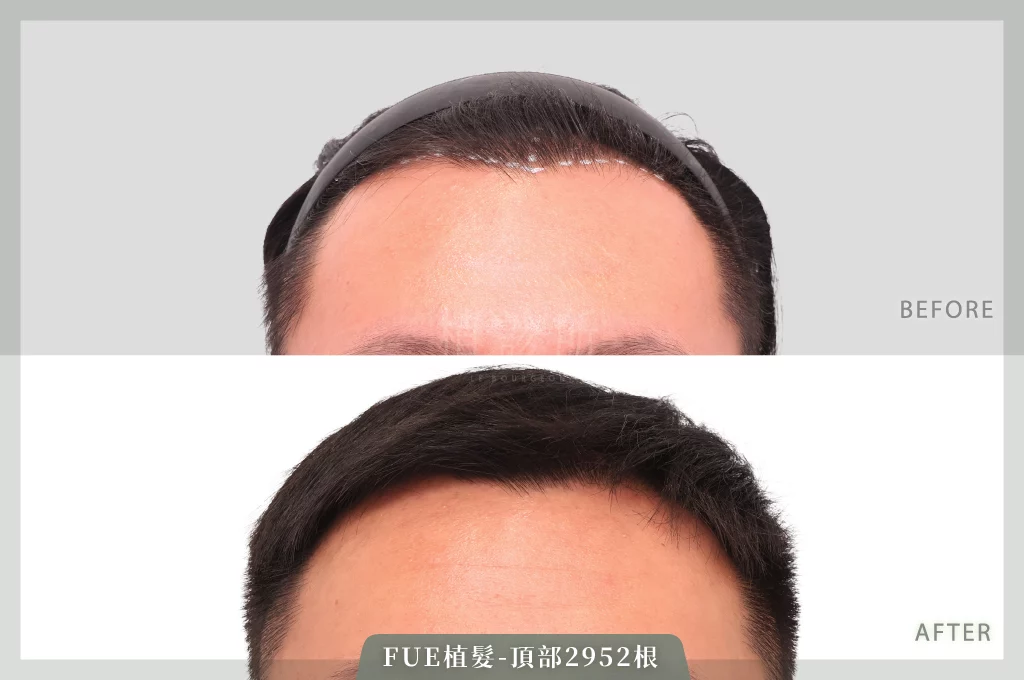 20260108 FUE植髮 2952根 D 正面