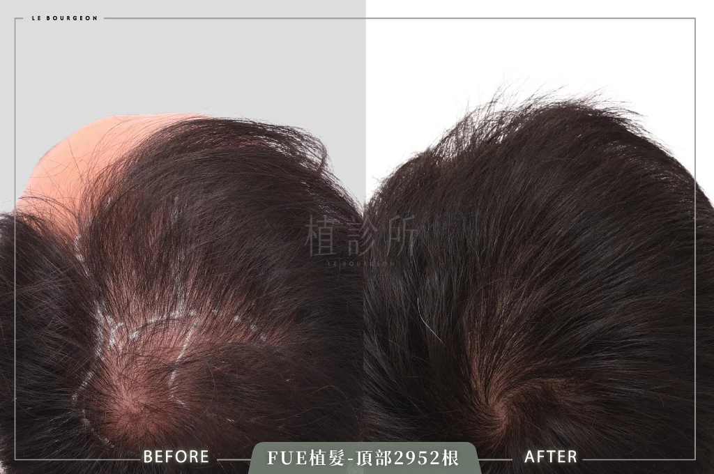20260108 FUE植髮 2952根 D 頭頂