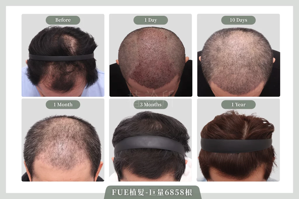 20260109 FUE植髮 6858根 成長圖 01