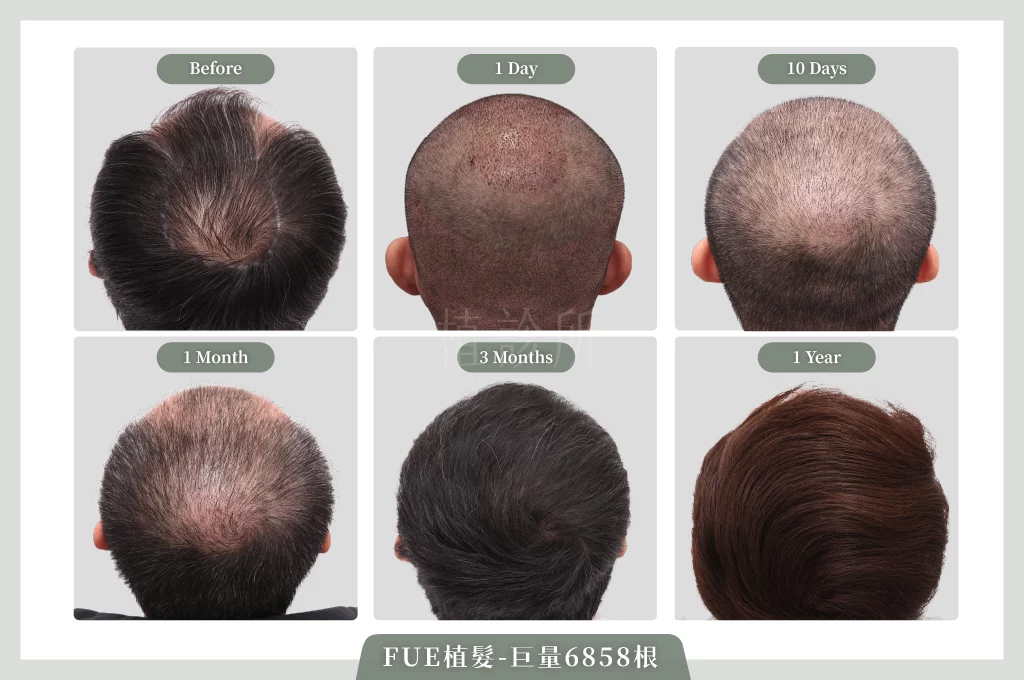 20260109 FUE植髮 6858根 成長圖 02