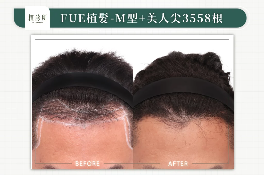 20260130 FUE植髮 3558根 L 大標 低頭