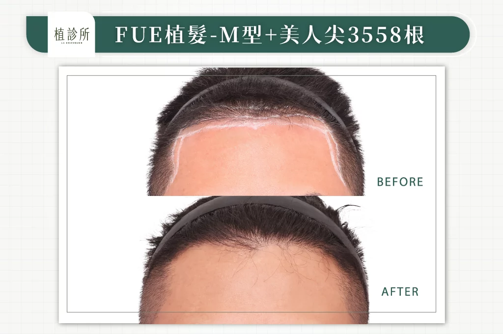 20260130 FUE植髮 3558根 L 大標 正面