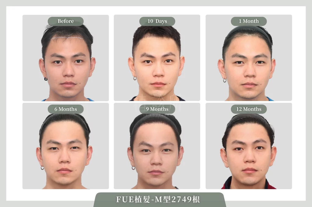 20260202 FUE植髮 2749根 成長圖