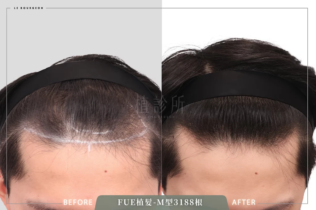 20260203 FUE植髮 3188根  C 低頭