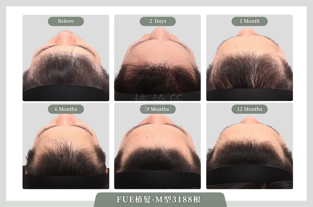 20260203 FUE植髮 3188根  C 成長圖