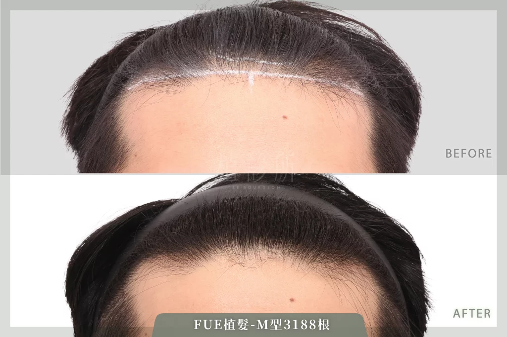 20260203 FUE植髮 3188根  C 正面