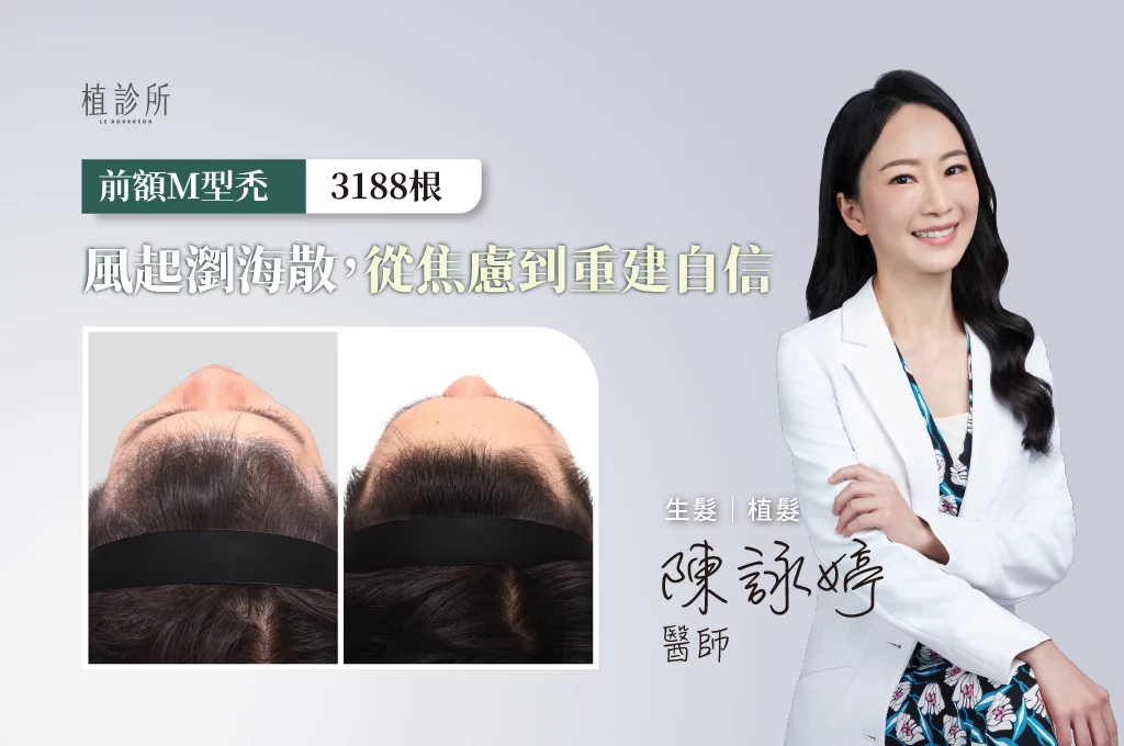 20260203 FUE植髮 3188根  C 陳詠婷醫生