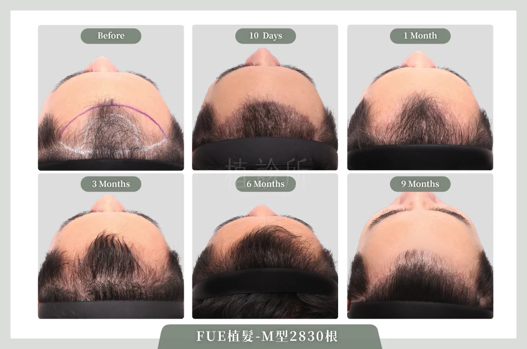 20260223 FUE植髮 2830根