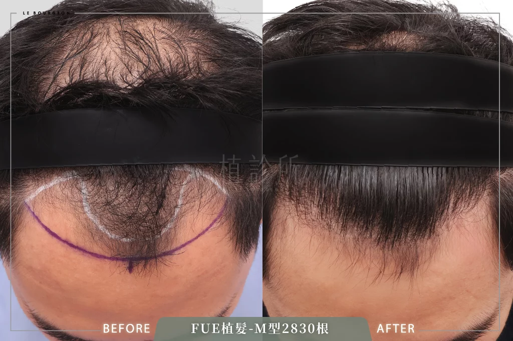 20260223 FUE植髮 2830根 低頭