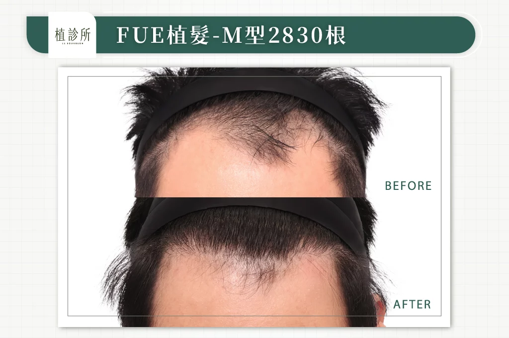 20260223 FUE植髮 2830根 大標 正面