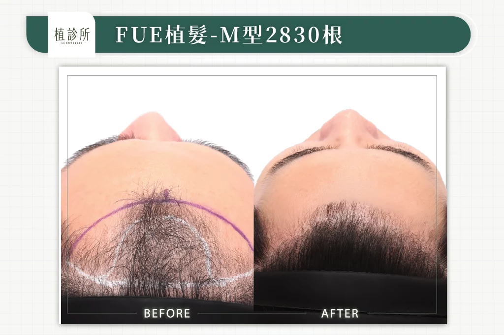 20260223 FUE植髮 2830根 大標 頭頂
