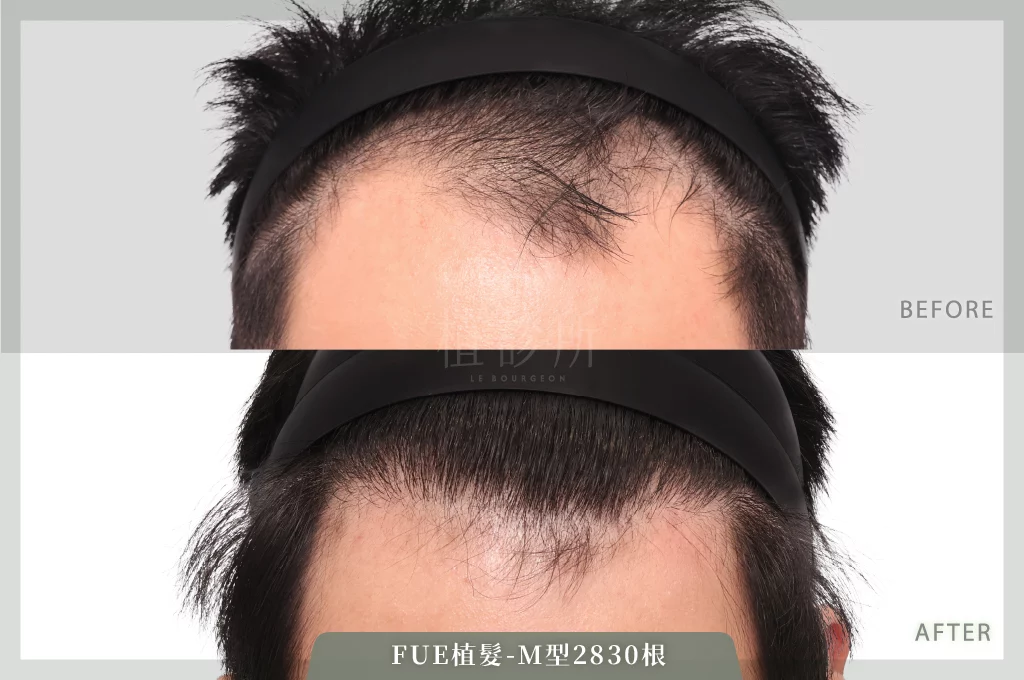 20260223 FUE植髮 2830根 正面