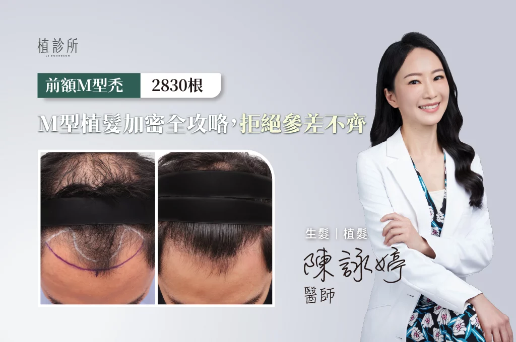20260223 FUE植髮 2830根 陳詠婷醫生