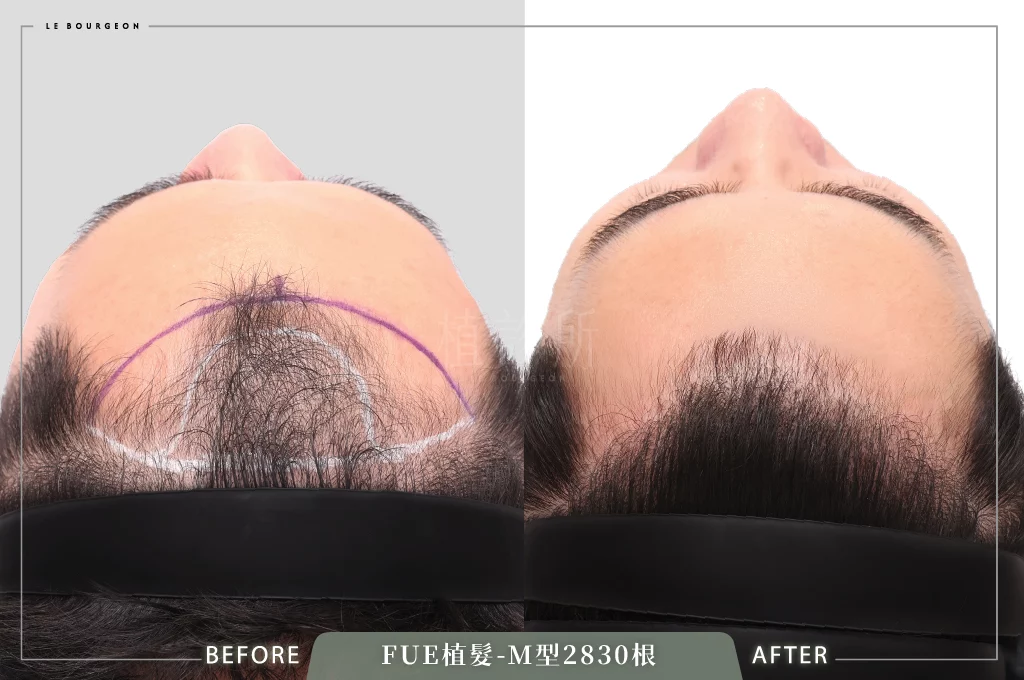 20260223 FUE植髮 2830根 頭頂