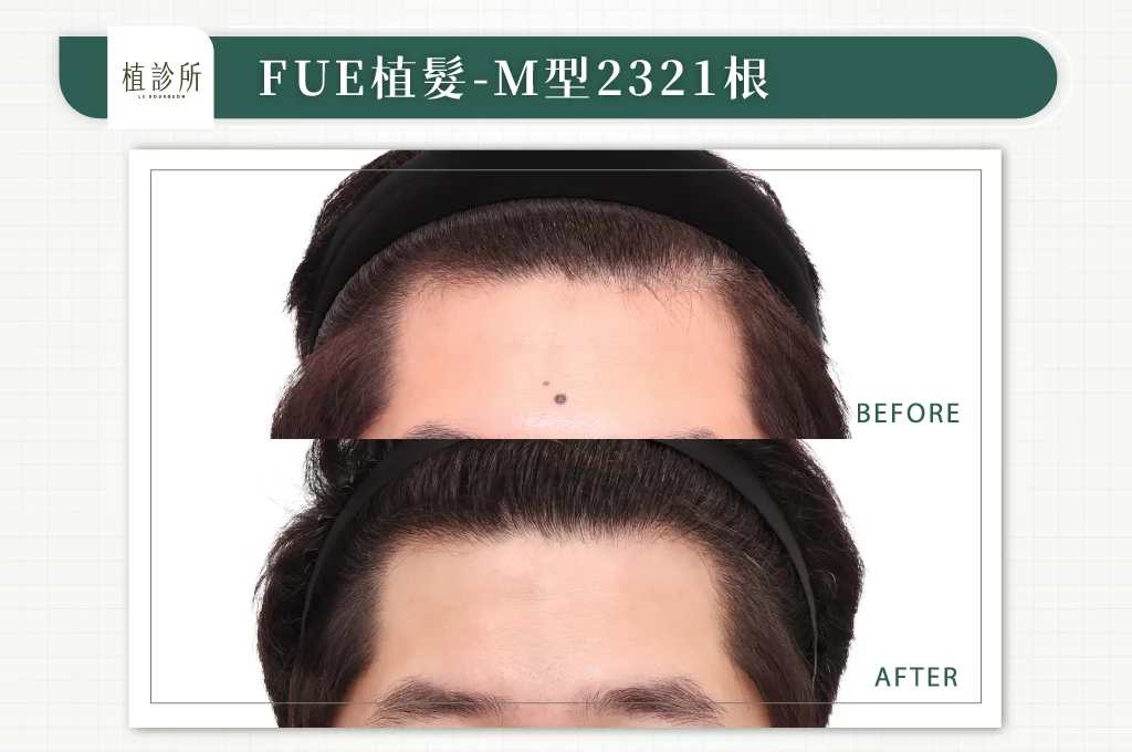 20260309 FUE植髮 2321 大標 正面
