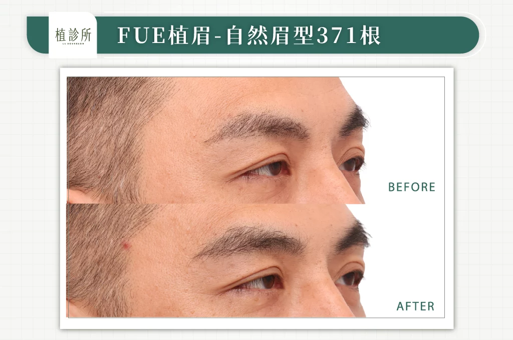 FUE植眉 吳旺根 右側面 官網