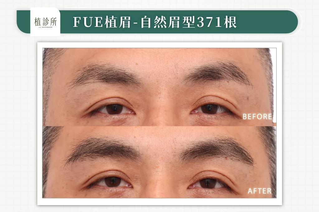 FUE植眉 吳旺根 右側面 官網 1