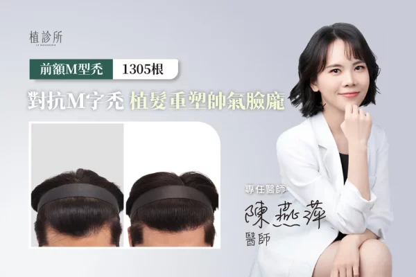 L先生 FUE植髮 1305根