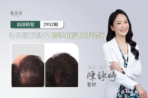 20260108 FUE植髮 2952根 Ｄ 陳詠婷醫生
