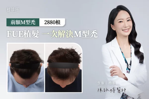 植髮 M型禿