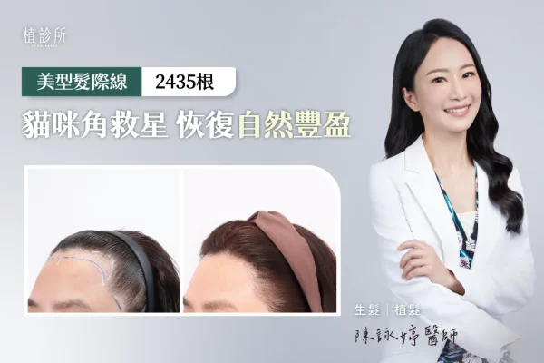 貓咪角 髮際線